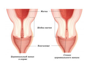 Матка сомкнута что это