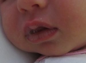 Пузырь на губе у новорожденного