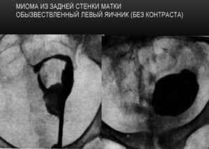 Миома задней стенки матки