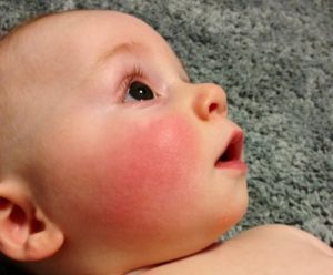 Почему у младенца щеки красные