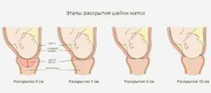 Какие ощущения при раскрытии шейки матки перед родами