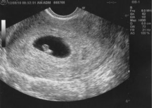 На 6 неделе беременности мажет