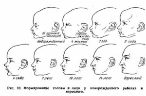 Форма головы у новорожденных норма