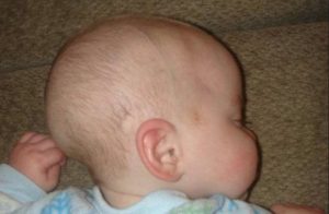 Вытянутая форма головы у новорожденного