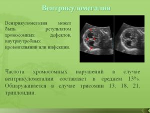 Вентрикуломегалия у плода лечение