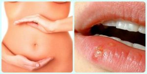 Простуда на губе при беременности 2 триместр лечение