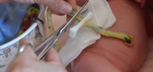 Как обрезают пуповину новорожденному