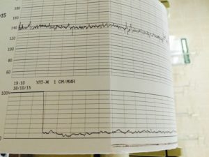 Если ребенок не шевелится во время ктг