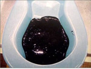 Почему кал у беременной черного цвета