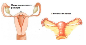 Маленькая матка что делать