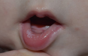 Белые пятна на губах у ребенка