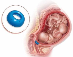 Акушерское кольцо при беременности
