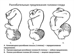 Разгибательные предлежания плода реферат