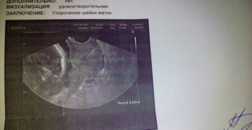 Шейка матки 26 мм на 26 неделе беременности