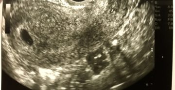 Если на 5 неделе беременности не видно эмбриона