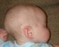 Долихоцефалическая форма головы у новорожденных