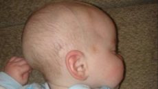Форма головы у новорожденных вытянутая