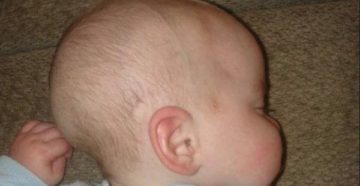 Форма головы у новорожденных вытянутая